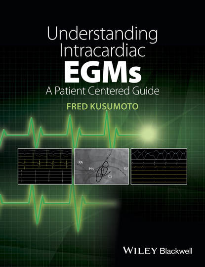 Understanding Intracardiac EGMs. A Patient Centered Guide