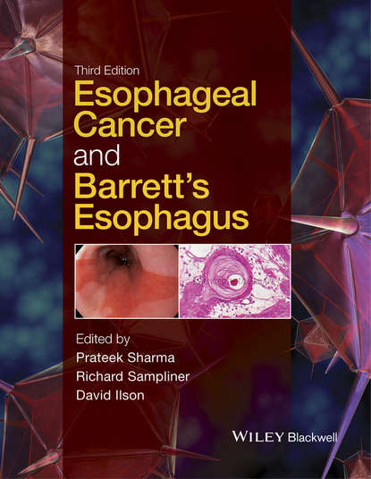 Esophageal Cancer and Barrett&apos;s Esophagus