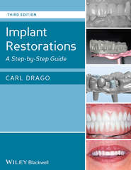 Implant Restorations. A Step-by-Step Guide