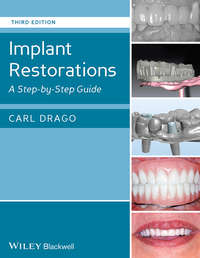 Implant Restorations. A Step-by-Step Guide