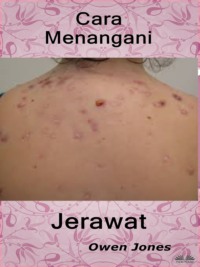 Cara Menangani Jerawat