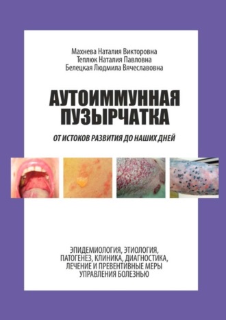 Аутоиммунная пузырчатка. От истоков развития до наших дней