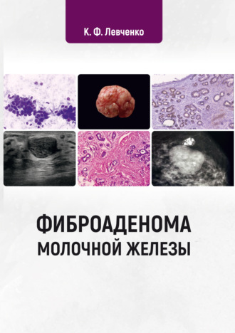 Фиброаденома молочной железы